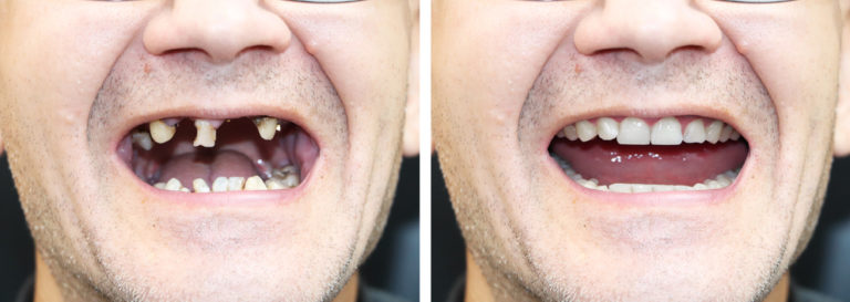 Meth mouth is one of the harmful physical effects of meth addiction. Since the illness is treatable, it's never too late as well to get treatment to reclaim a healthy life mentally and physically.